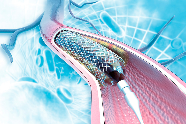stent